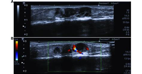 Ultrasound evaluation of the eccrine spiradenoma on the right leg ...