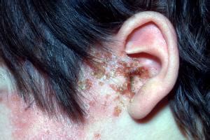 Shingles Rash On Face