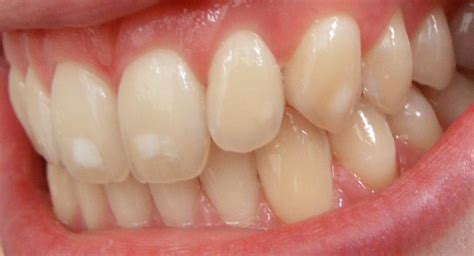 Dental fluorosis - Wikipedia