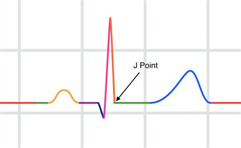 J point ECG