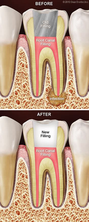 Root Canal Retreatment - My Primary Dental