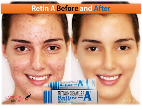 Retin A Before and After – Cosmetics and you : Acne Treatment, Careprost Eyelashes, Careprost ...