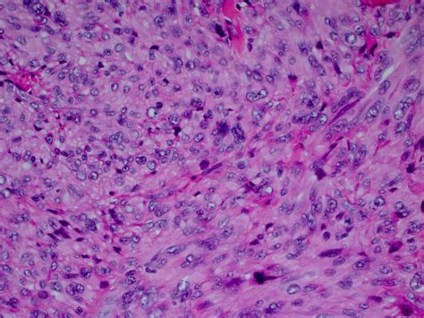 Pathology Outlines - Leiomyosarcoma