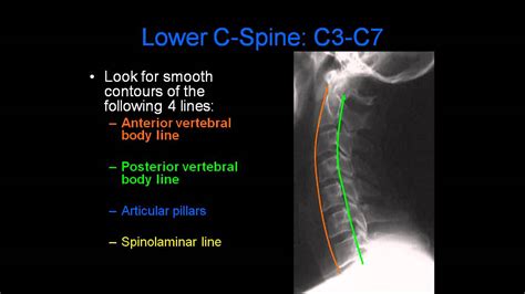 Cervical Spine Xray