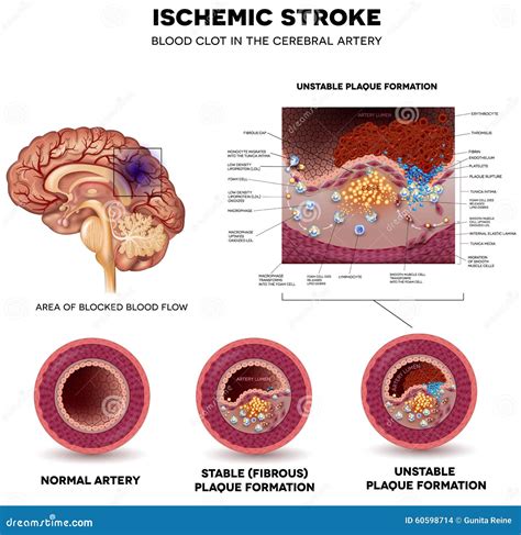 Atherosclerosis. Stable Plaque Formation Vector Illustration | CartoonDealer.com #60594162