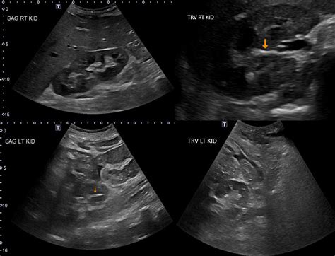 Renal ultrasonography: a reliable diagnostic tool for pyonephrosis ...