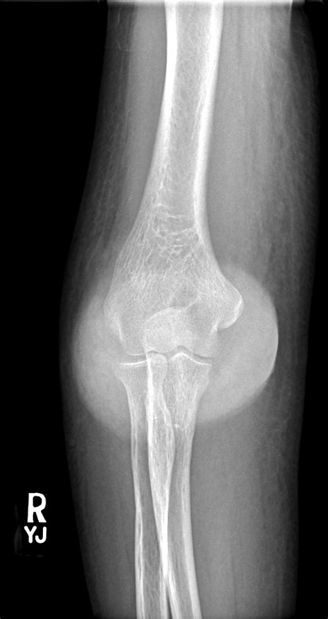 Gouty arthropathy | Image | Radiopaedia.org