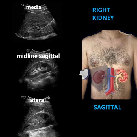 Renal Ultrasound Complete Protocol – Sonographic Tendencies