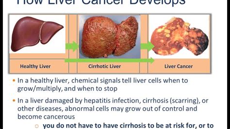 Is There A Cure For Cancer Of The Liver - CancerWalls