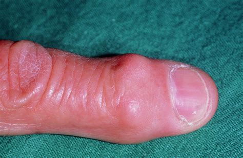 Heberden's Node On Finger In Osteoarthritis Photograph by Dr P. Marazzi/science Photo Library