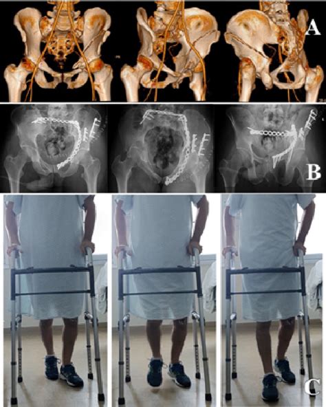 Clinical case of early weight bearing after ORIF for unstable pelvic... | Download Scientific ...