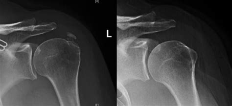 Boston Sports | rotator cuff calcification, shoulder calcification, shoulder surgery, barbotage ...