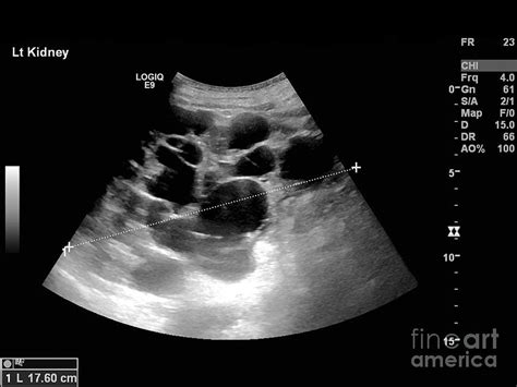 Polycystic Kidney, Ultrasound Scan Photograph by Science Photo Library ...