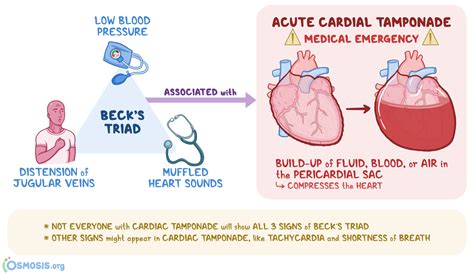 Beck’s Triad: What Is It, Associated Conditions, and More | Osmosis