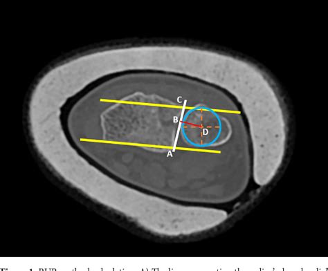 Figure 1 from Displaced sigmoid notch fracture and higher patient age are associated with distal ...