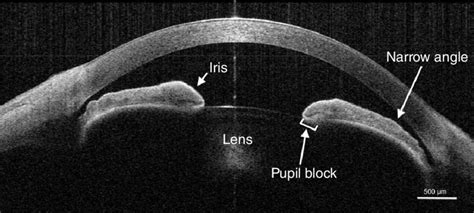 Anterior segment optical coherence tomography (AS-OCT) of phacomorphic ...