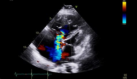 Evidence for Pulmonary Hypertension Favors Lower Threshold - Vanderbilt Discover