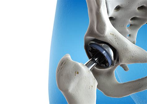 Joint Replacement - Austin, TX - Orthopaedic Specialists of Austin