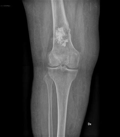 apa gambaran radiologi khas pada chondrosarcoma