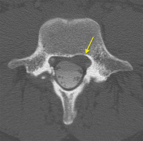 Cureus | Symptomatic Lumbar Discal Cyst: A Rare Entity that Can Mimic Other Lumbar Cystic Lesions