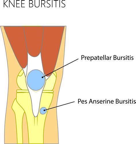Knee Bursitis — Adam B. Cohen, MD