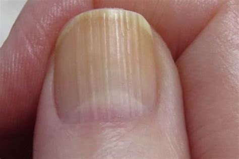 Ridges in Fingernails, Beau's, Lines, Horizontal, Vertical, Pictures, Causes, Treatment & Home ...