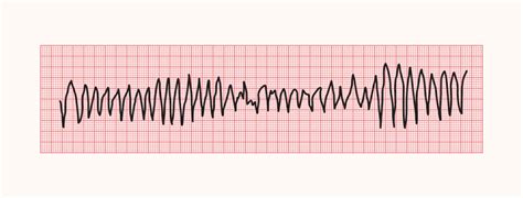 Torsades de pointes: guia de ECG – PEBMED