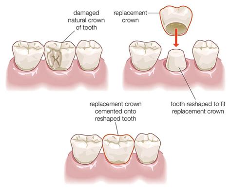 Dental Crowns | Dental Esthetics Center