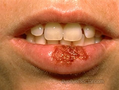 Oral Herpes – Symptoms, Pictures, Causes, Treatment