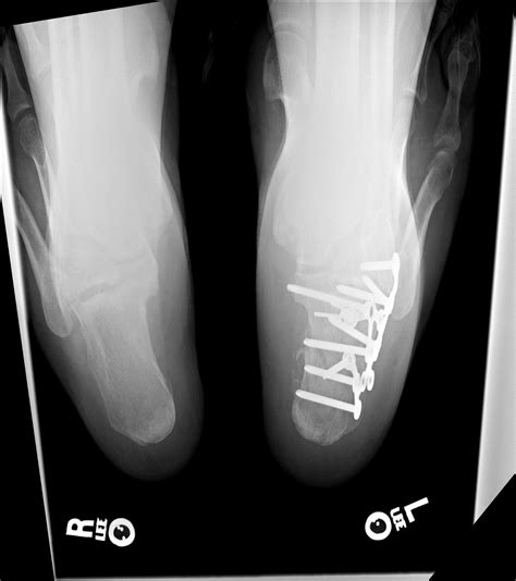 Calcaneus fracture - freeloadstek