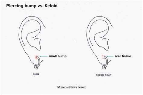 Piercing bump vs. keloid: How to tell the difference and what to do ...