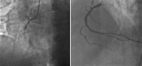 Cureus | Extremely Late In-Stent Thrombosis 12 Years After Implantation ...