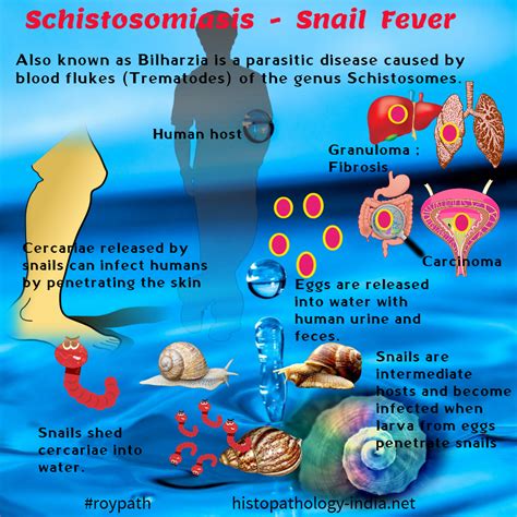 Pathology of Schistosomiasis #roypath | Pathology, Infectious disease, Disease