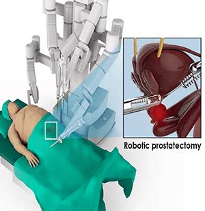 Green Light Laser Prostate Surgery Post Op | Shelly Lighting