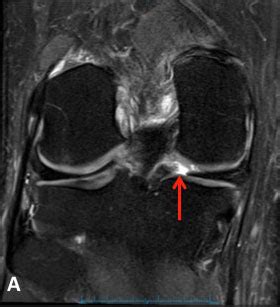 Meniscal Root Tears | Knee Specialist | Minnesota