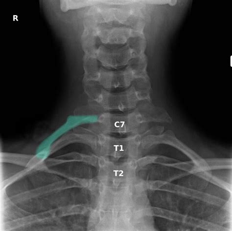 Thoracic Outlet Syndrome X Ray