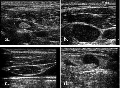 Nodal echogenic hilum: a) benign node with echogenic central hilum; b)... | Download Scientific ...