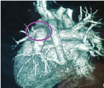 Sutureless Repair of Left Primary Pulmonary Vein Stenosis—A Case Report