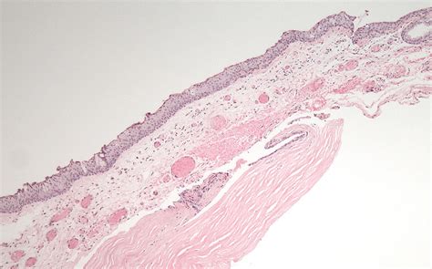 Ocular Cicatricial Pemphigoid: atypical presentation. EyeRounds.org - The University of Iowa