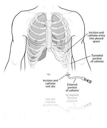 Placement and Care of your Aspira Drainage Catheter (Interventional Radiology) | Health and ...