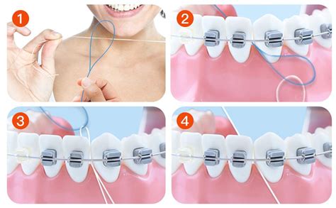 Amazon.com : VINSULLA Floss Threaders for Braces, Bridges, and Implants ...