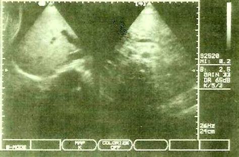 Ultrasound of liver and pancreas. | Download Scientific Diagram