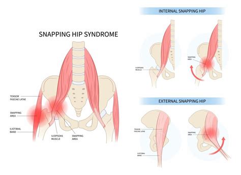 Snapping Hip Syndrome