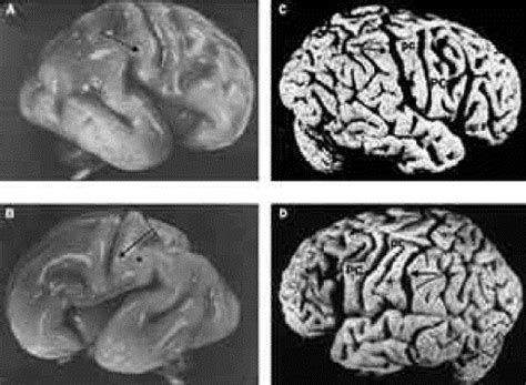 Albert Einstein's brain - The Lancet