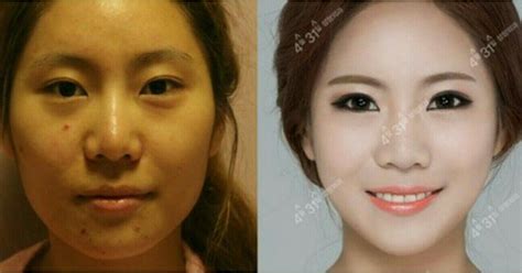 April31 Plastic Surgery Clinic: Korean Plastic Surgery - Facial Contouring by Dr. Sung Wan Park ...