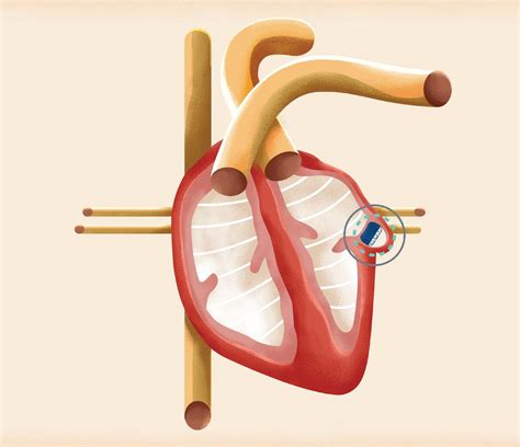 The Watchman Device Prevents Blood Clots in the Heart