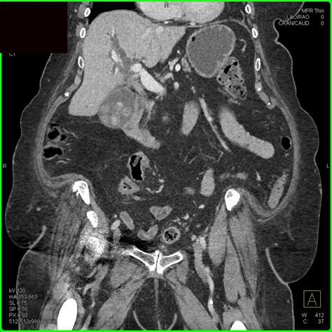 Multiple Gallstones in the Gall Bladder - Liver Case Studies - CTisus CT Scanning