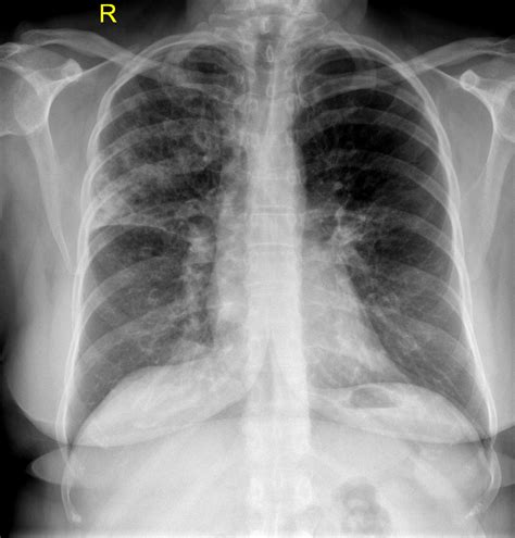 Right upper lobe pneumonia | Radiology Case | Radiopaedia.org ...