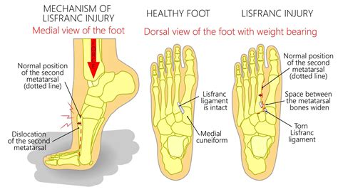 Lisfranc Injury | Lisfranc Fracture | We answer, "What is a Lisfranc Injury"?