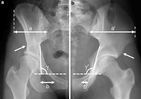 Acetabular retroversion is the result of an externally rotated... | Download Scientific Diagram